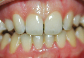 Расширение зубных рядов